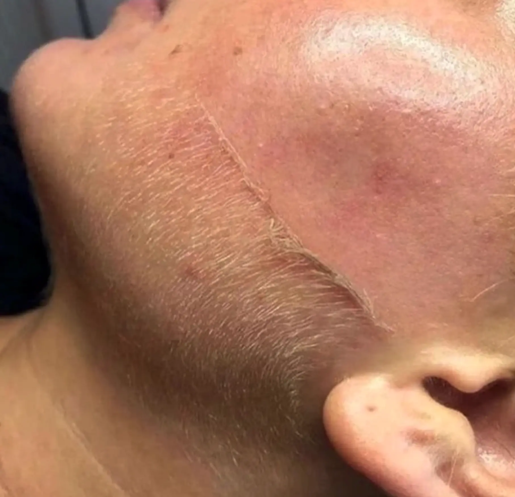 Dermaplaning