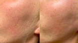 Should Men Get Dermaplaning