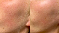 Should Men Get Dermaplaning