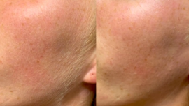 Should Men Get Dermaplaning