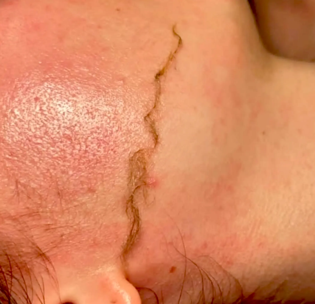 Treatment Timeline & Aftercare