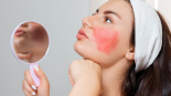 Woman applying moisturizer with a stinging sensation on her face