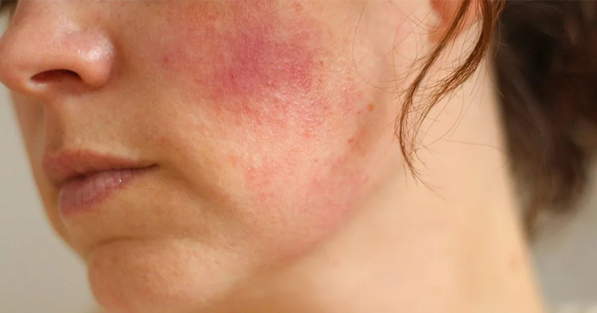 Close-up of woman's face reacting to moisturizer with a stinging feeling