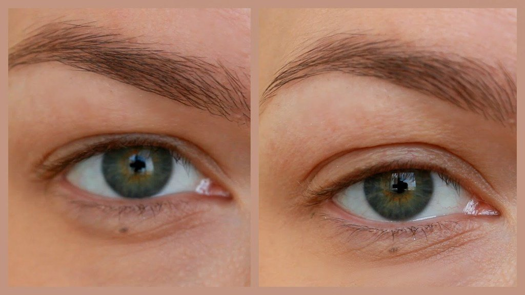 Professional cosmetic procedures for treating deep eye sockets and achieving a youthful appearance