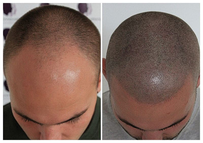 Training to become a scalp micropigmentation artist