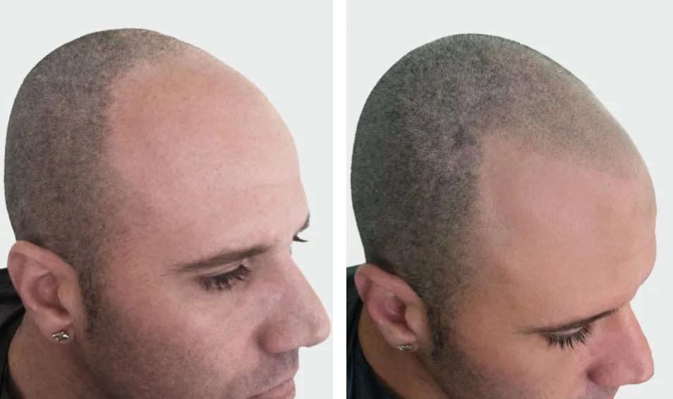 Mastering scalp micropigmentation artist skills